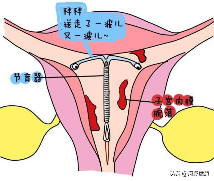 上环白带多怎么办_上环白带多怎么办_上环白带多怎么办