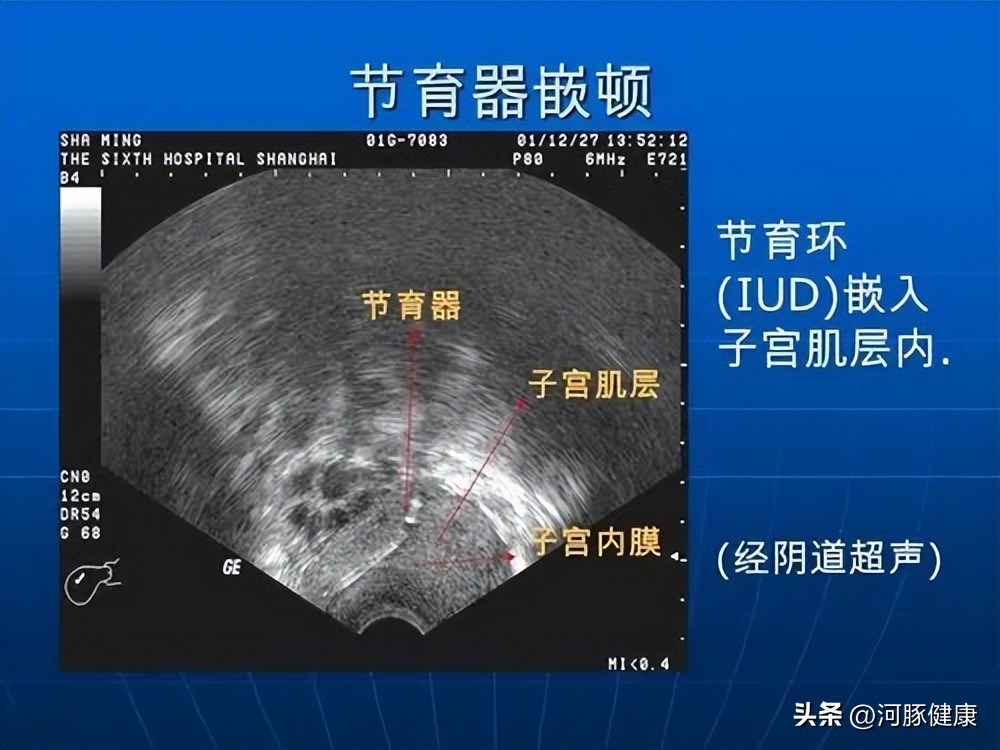 上环白带多怎么办_上环白带多怎么办_上环白带多怎么办
