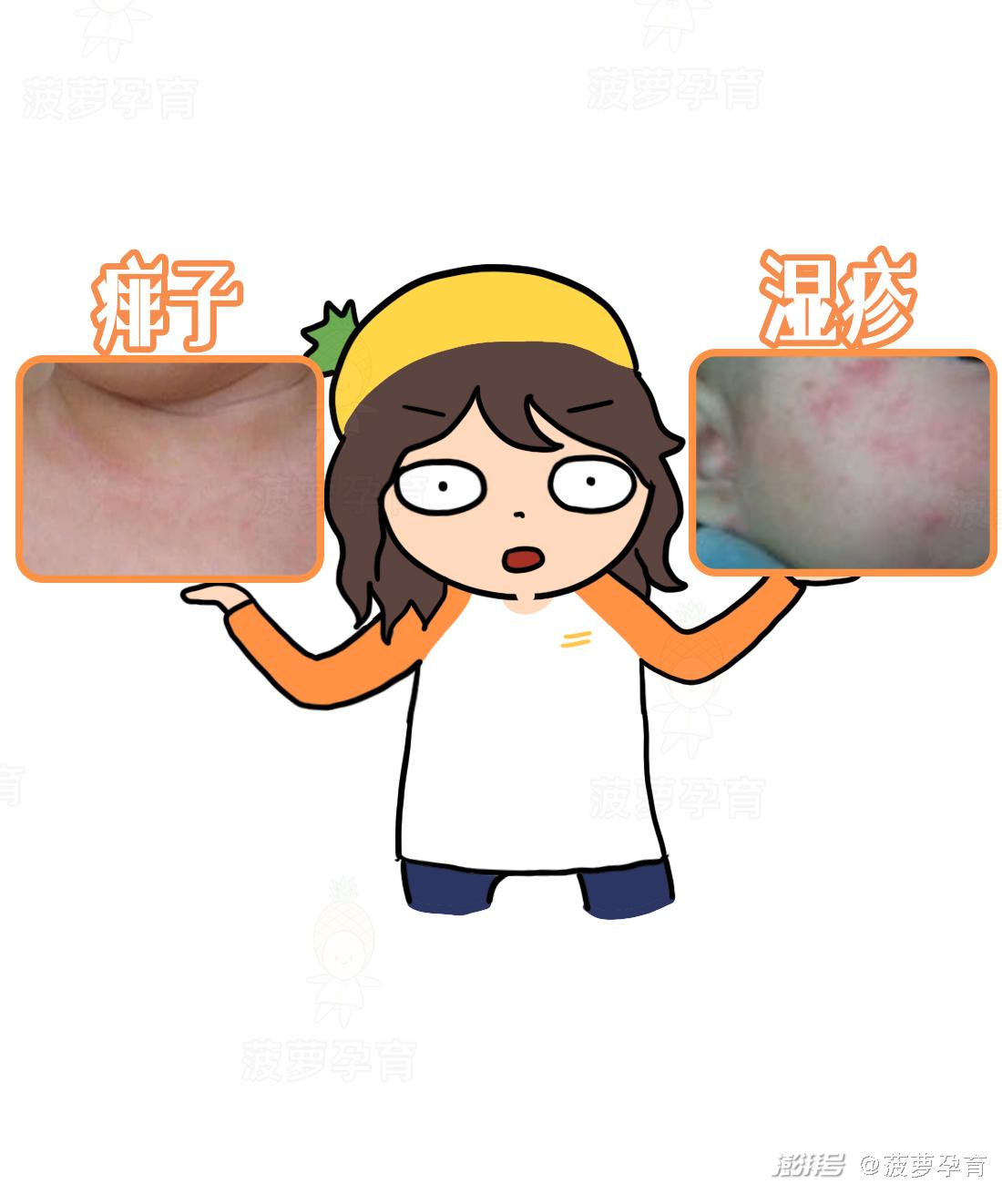 feng tuan_湿疹与痱子区别_宝宝皮肤问题图谱