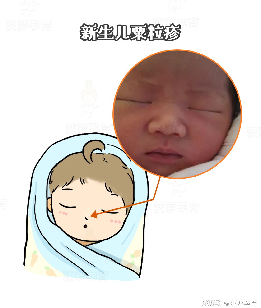 feng tuan_湿疹与痱子区别_宝宝皮肤问题图谱