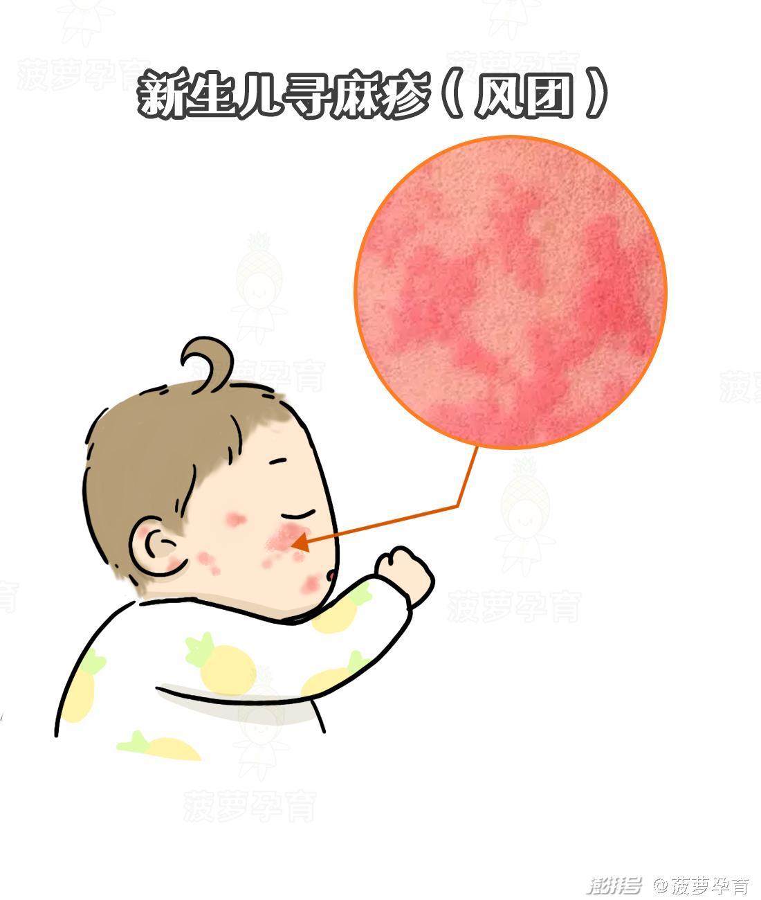 湿疹与痱子区别_宝宝皮肤问题图谱_feng tuan
