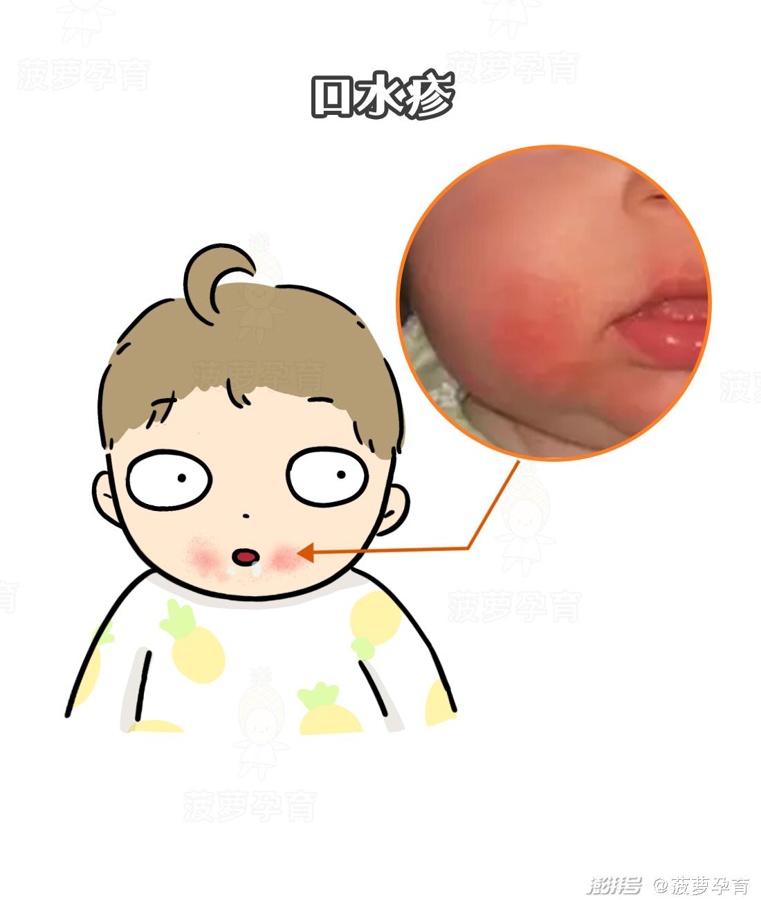 宝宝皮肤问题图谱_feng tuan_湿疹与痱子区别