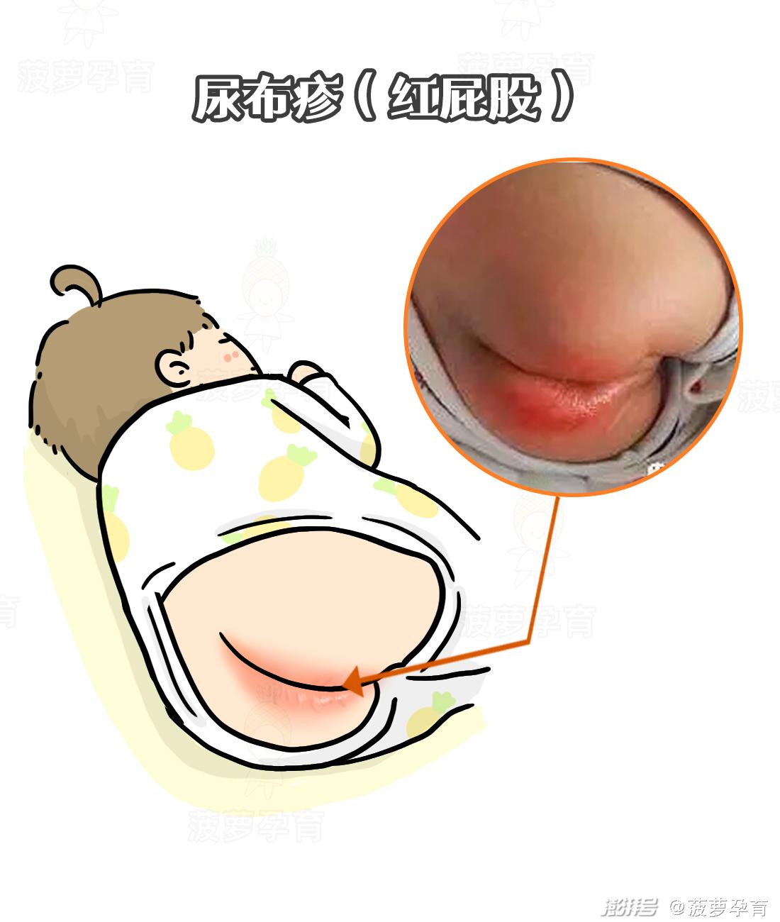 宝宝皮肤问题图谱_湿疹与痱子区别_feng tuan