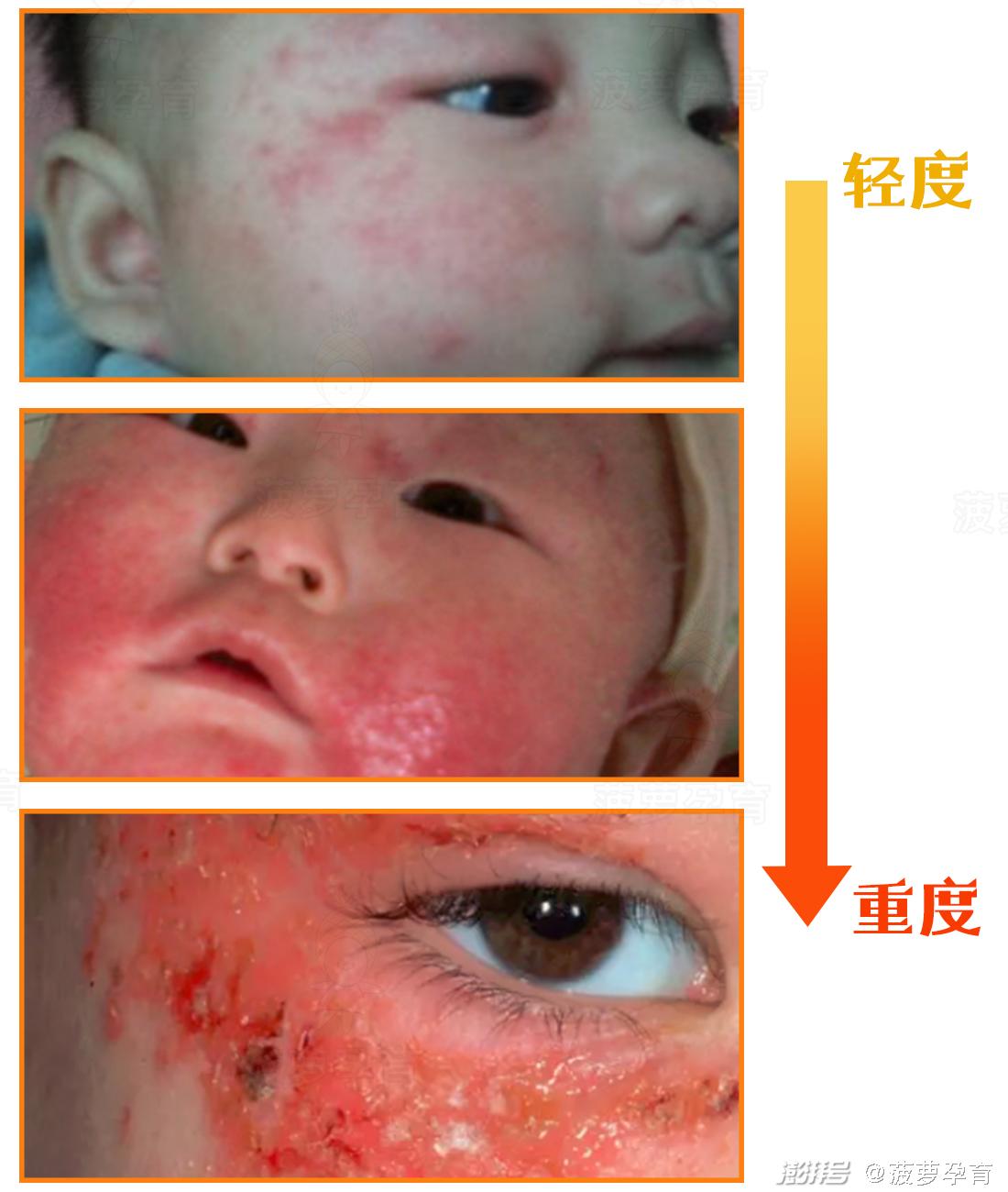 湿疹与痱子区别_feng tuan_宝宝皮肤问题图谱